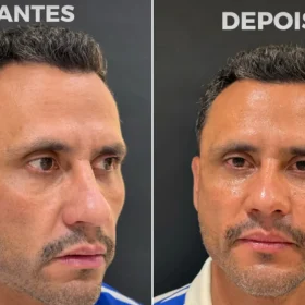 Um dia após ser eleito, Cleitinho faz procedimentos estéticos no rosto