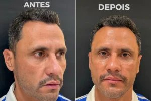 Um dia após ser eleito, Cleitinho faz procedimentos estéticos no rosto