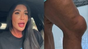 Gracyanne Barbosa revela joelho inchado e dificuldades após lesão no Dança dos Famosos
